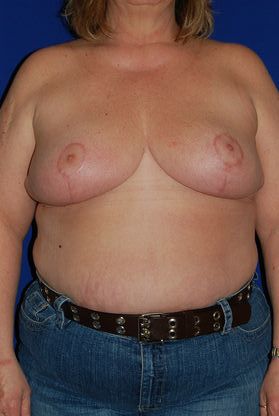 After breast reduction